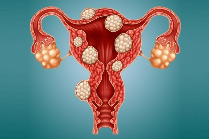 Signs and Symptoms of Ovarian Cysts
