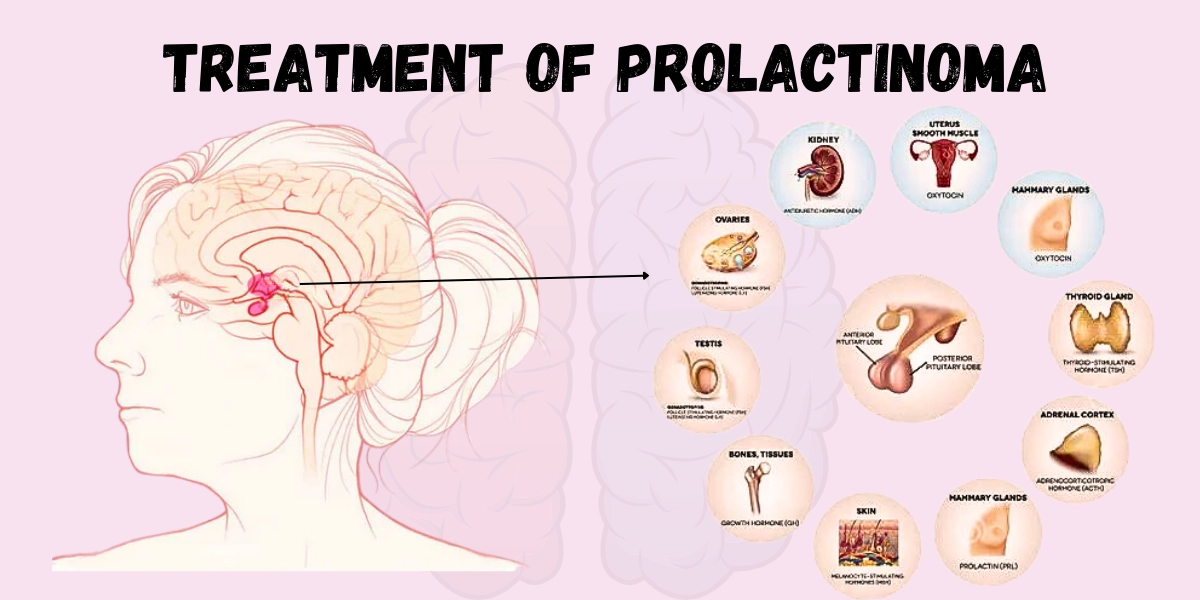 Treatment of Prolactinoma